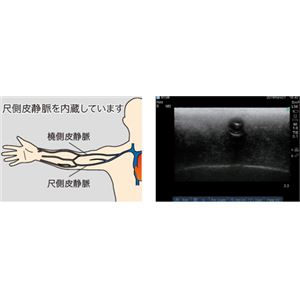 エコーガイドPICCトレーナー(静脈穿刺トレーニング/看護実習モデル) コンパクトサイズ 肘正中皮静脈対応 M-196-0 商品写真2